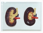Relief model of anat kidney