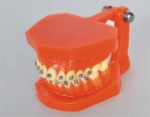 Metal bracket orthodonics model